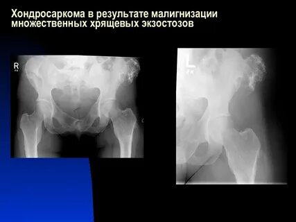 Хондросаркома