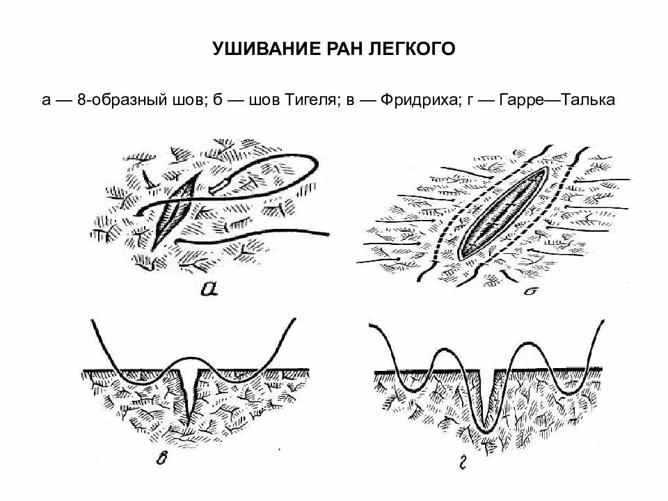 Ушивание раны легких шов. Как называется шов после операции