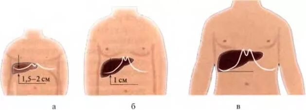 Увеличена печень в год. Печень по краю реберной дуги у детей. Печень выступает из под края реберной дуги. Расположение печени у детей.
