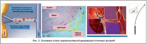 Почечная денервация