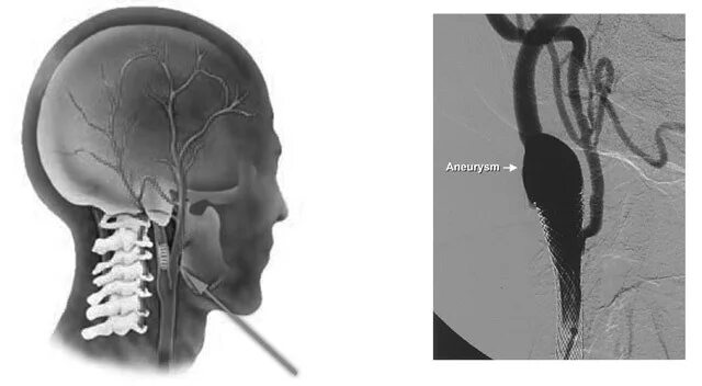 Аневризма сонной артерии что это. Аневризма сонной артерии головного мозга. Аневризма левой ВСА головного мозга. Аневризма сонной артерии шеи кт мрт.