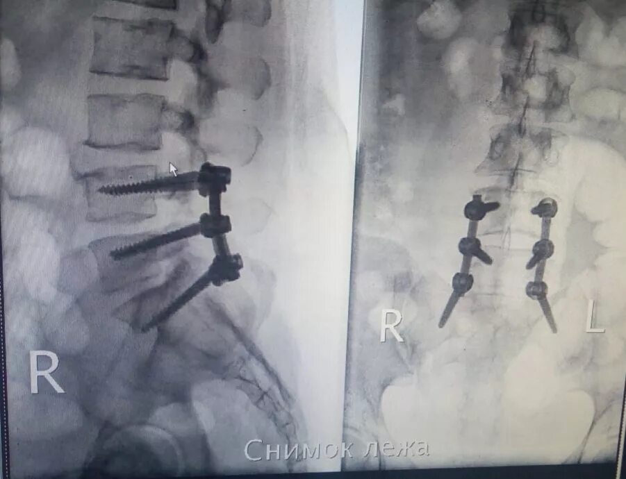 Металлоконструкция в позвоночнике поясничного. Операции на позвоночнике поясничного отдела. Металлоконструкция позвонка. Металлоконструкция в позвоночнике а шурупами. Сидеть после операции на позвоночнике поясничного