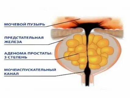 Аденома простаты операция