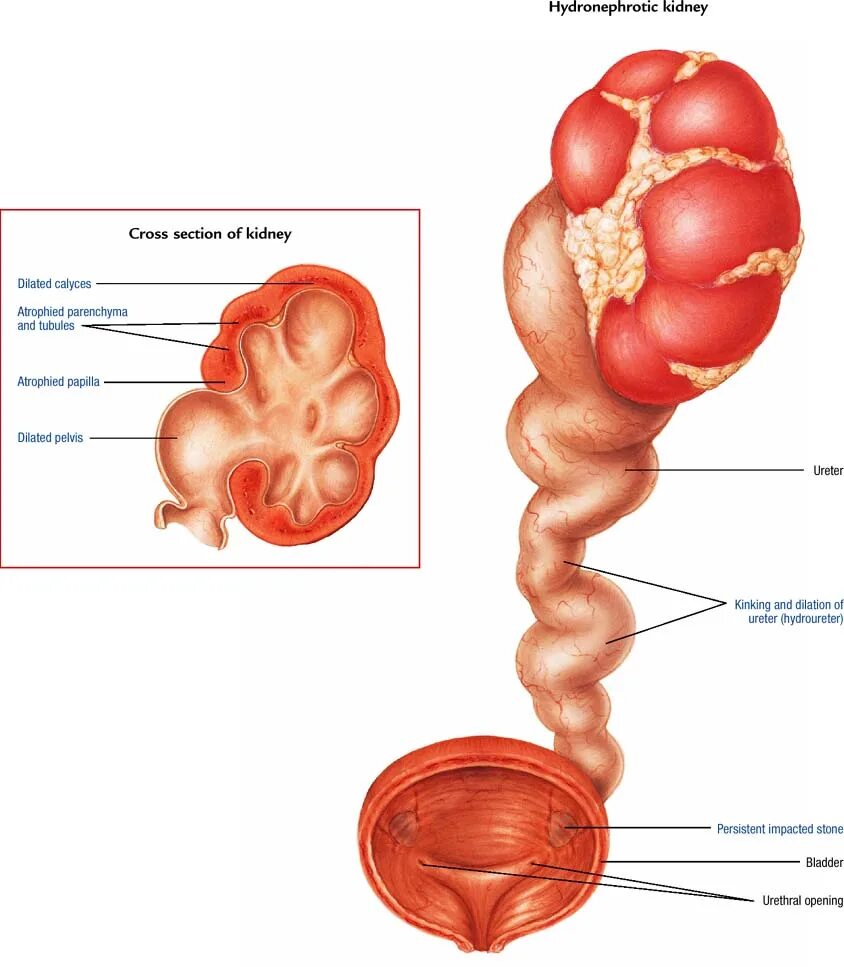 Заболевание почек гидронефроз. Клапан мочеточника гидронефроз. Гидронефроз добавочный сосуд. Врожденный гидронефроз.
