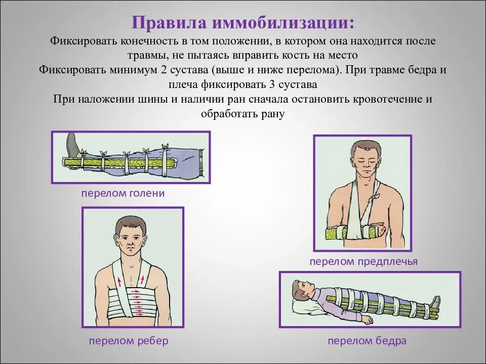 Алгоритм помощи при переломах. Иммобилизация при переломе бедра ОБЖ. Основное правило иммобилизации при переломах костей конечностей.. Мобилизация конечности при переллмах. Иммобилизация при открытых переломах.