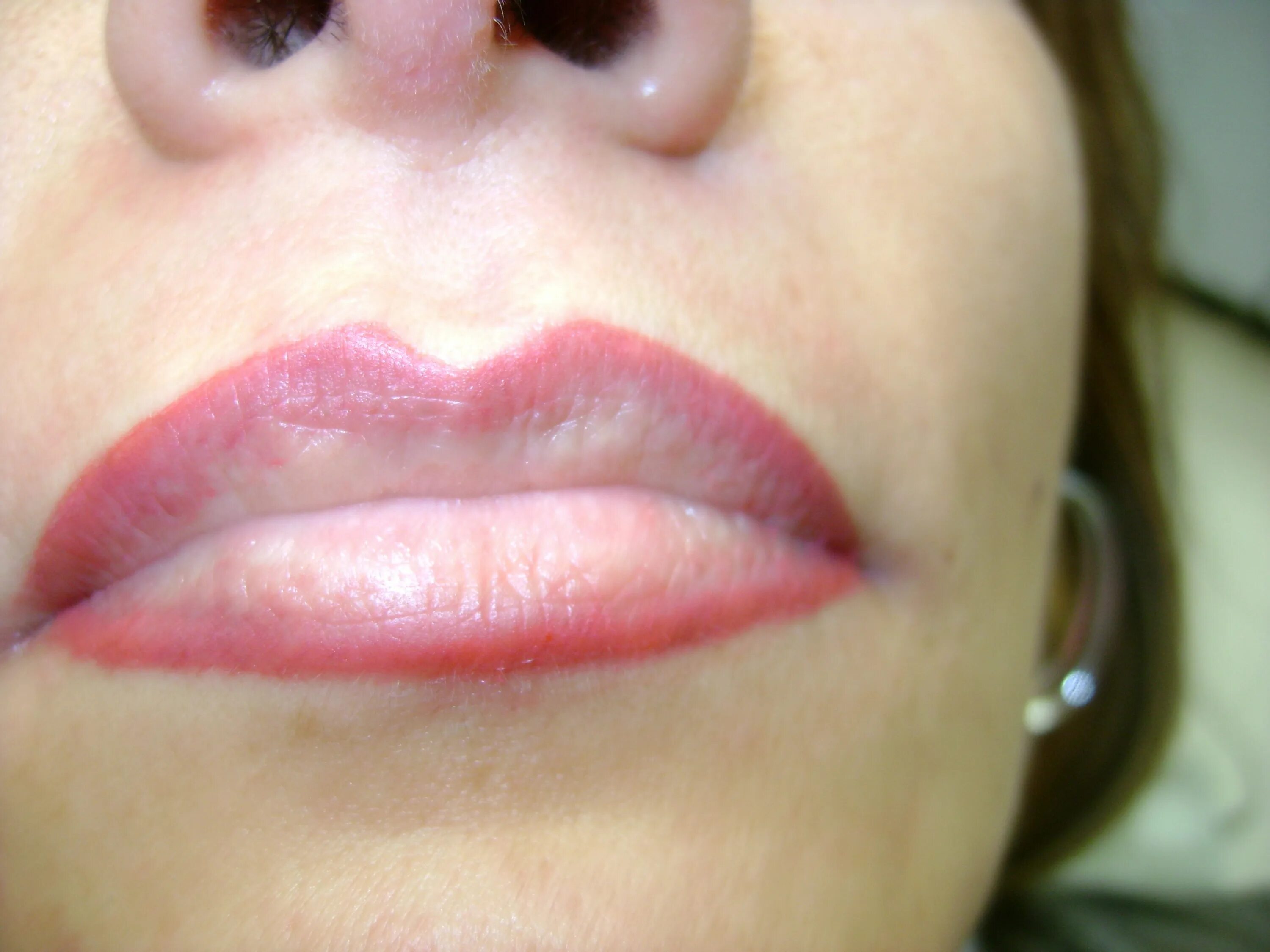 Ангулярный стрептококковый хейлит. Ангулярный стрептококковый хейлит. Пациент губа. Анестезия в косметологии. Пациент губа.