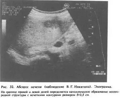 Очаговое образование левой печени