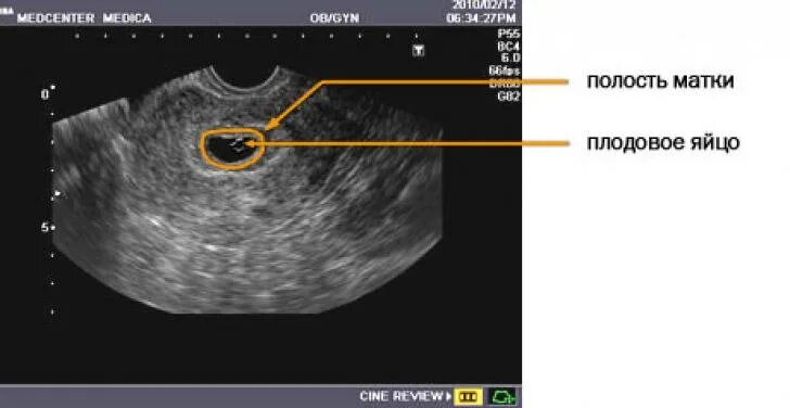 Ультразвуковое исследование беременности на ранних сроках. УЗИ картина беременность малого срока. Маточная беременность на УЗИ на раннем сроке.