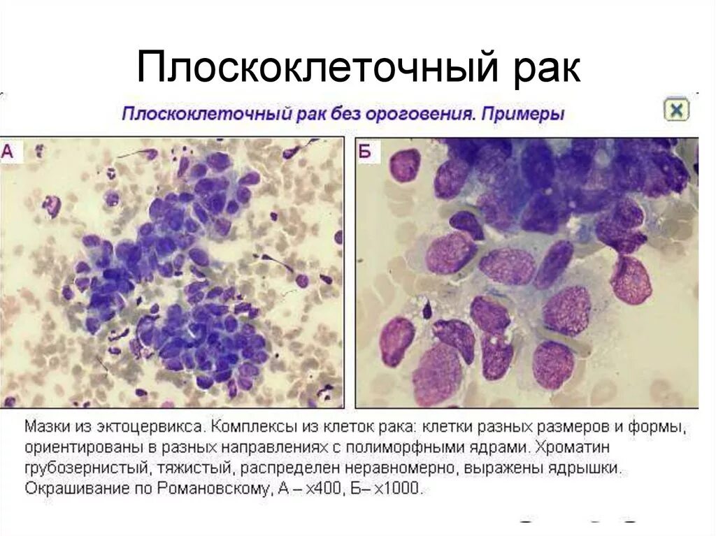 Плоскоклеточное поражение низкой степени. Беспигментная базалиома. Эпителиоидная меланома. Базальноклеточная карцинома гистология.