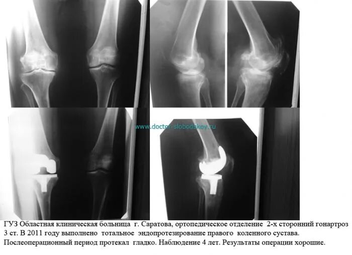 Гонартроз мрт. Гонартроз эндопротезирование. гонартроз коленного сустава рентген. гонартроз 3 степени коленного сустава рентген. ревизионное эндопротезирование коленного сустава рентген.