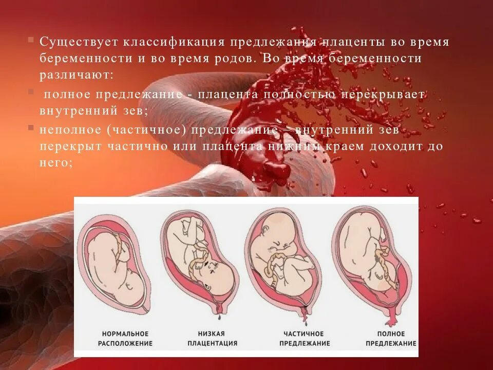 При низкой плацентации можно. Предлежание плаценты. Предлежание плаценты классификация. Полное предлежание плаценты. Частичное предлежание плаценты.