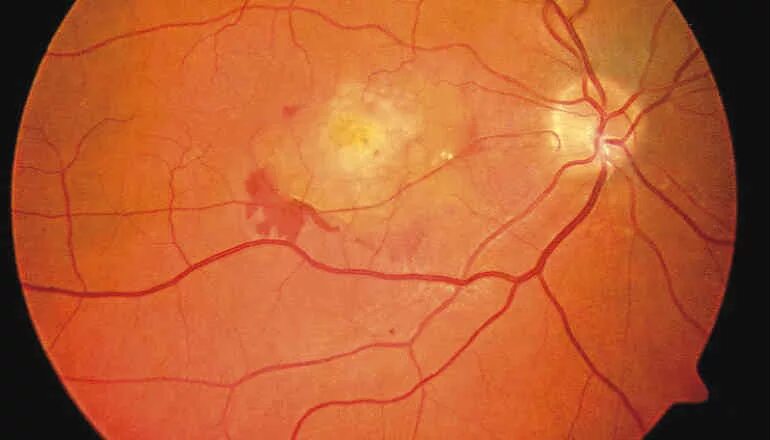 Ангиопатия сосудов мкб. Пролиферативная диабетическая ретинопатия. Геморрагическая ретинопатия. Посттромботическая ретинопатия.