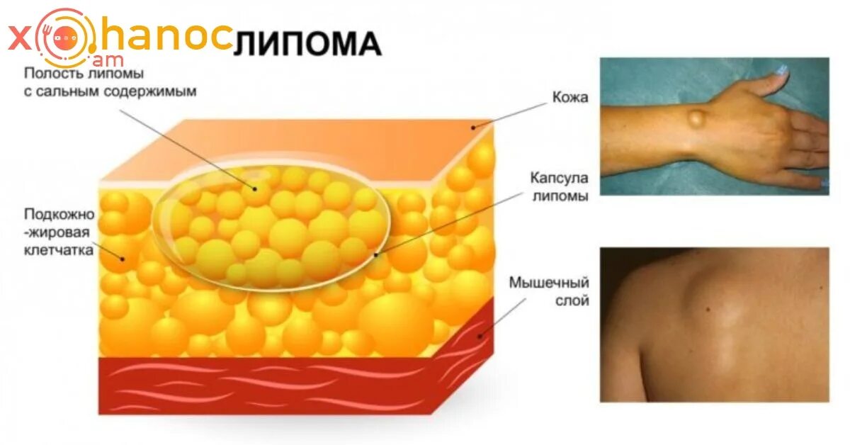 Жировик средства лечения