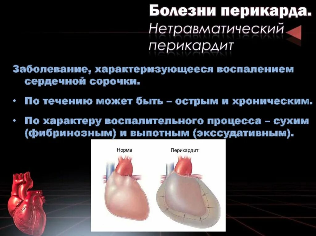 Перикардит симптомы и лечение. Перикардит (воспаление наружной сердечной оболочки). Нетравматический перикардит – (pericarditis). Строение перикарда.