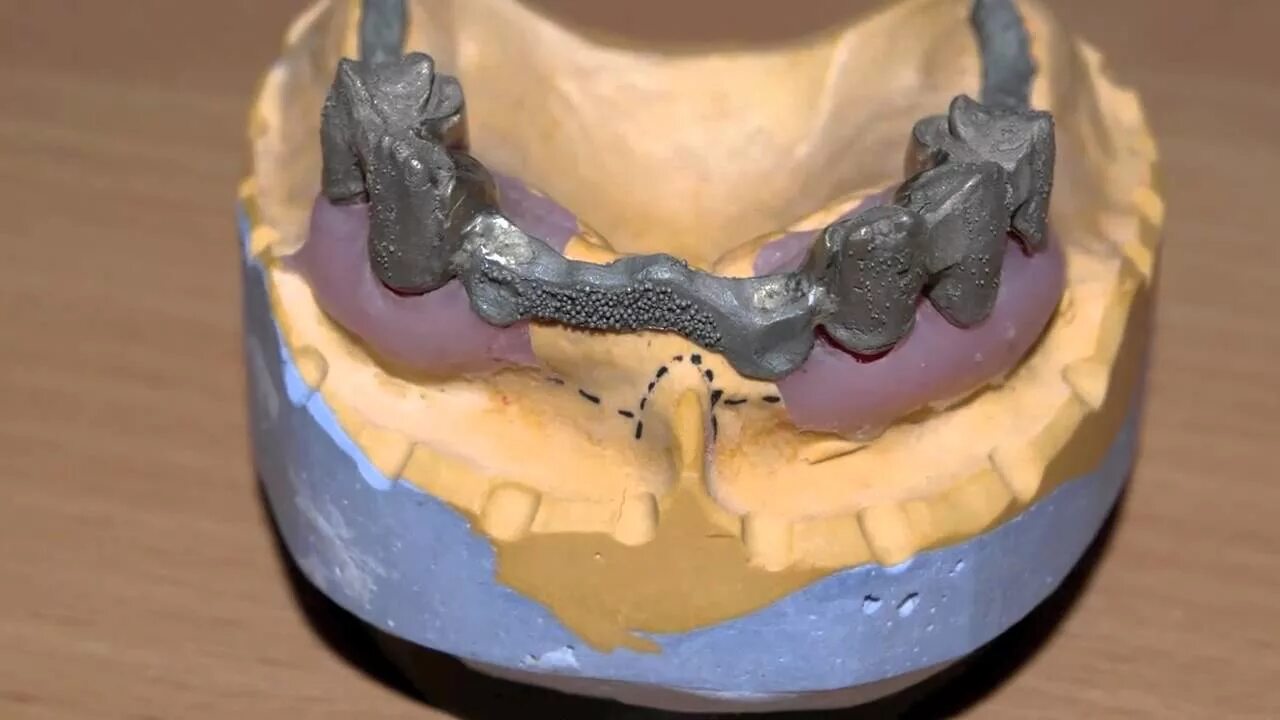 Моделировка бюгельного протеза. Телескопические коронки бюгельного протеза. Литниковая система бюгельного протеза. Литниковая система на бюгельный протез. Этапы изготовления бюгельных