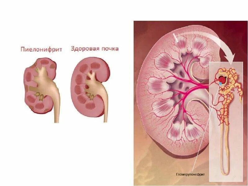 Больные почки у детей. Болезни почек пиелонефрит гломерулонефрит. острый левосторонний пиелонефрит. почка пораженная гломерулонефритом. болезнь почек пиелонефрит у детей.