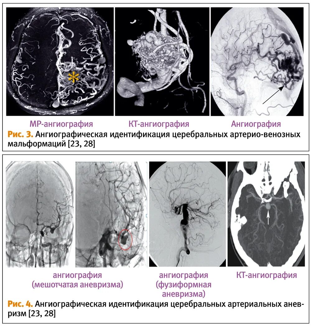 Форум аневризма мозга. Аневризма мальформация сосудов головного мозга. Сосудистая мальформация прямой кишки. Фузиформное расширение. Мальформация признаки.