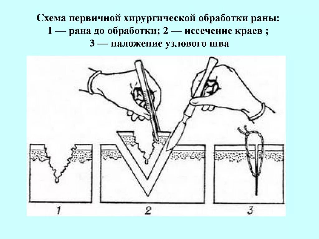 Первичная хирургическая обработка это. Схема первичной хирургической обработки раны. Первичная хирургическая обработка раны (Пхо). Первичная хирургическая обработка РАН (до 2 см). Этапы хирургической обработки РАН.