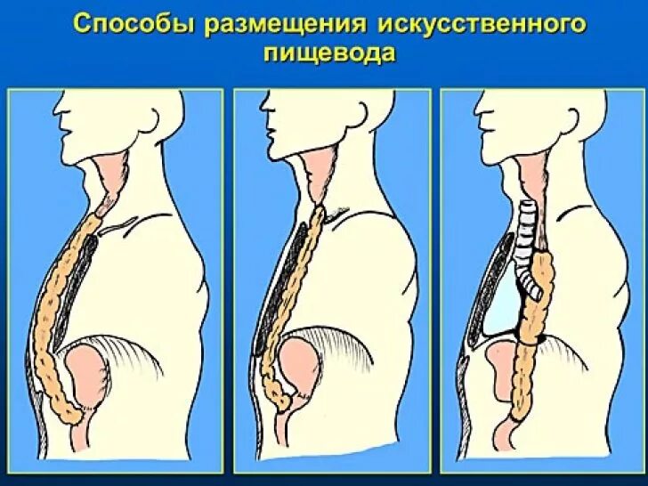 Операция ру Герцена Юдина. Пластика пищевода по ру-Герцену-Юдину. Способы пластики пищевода.