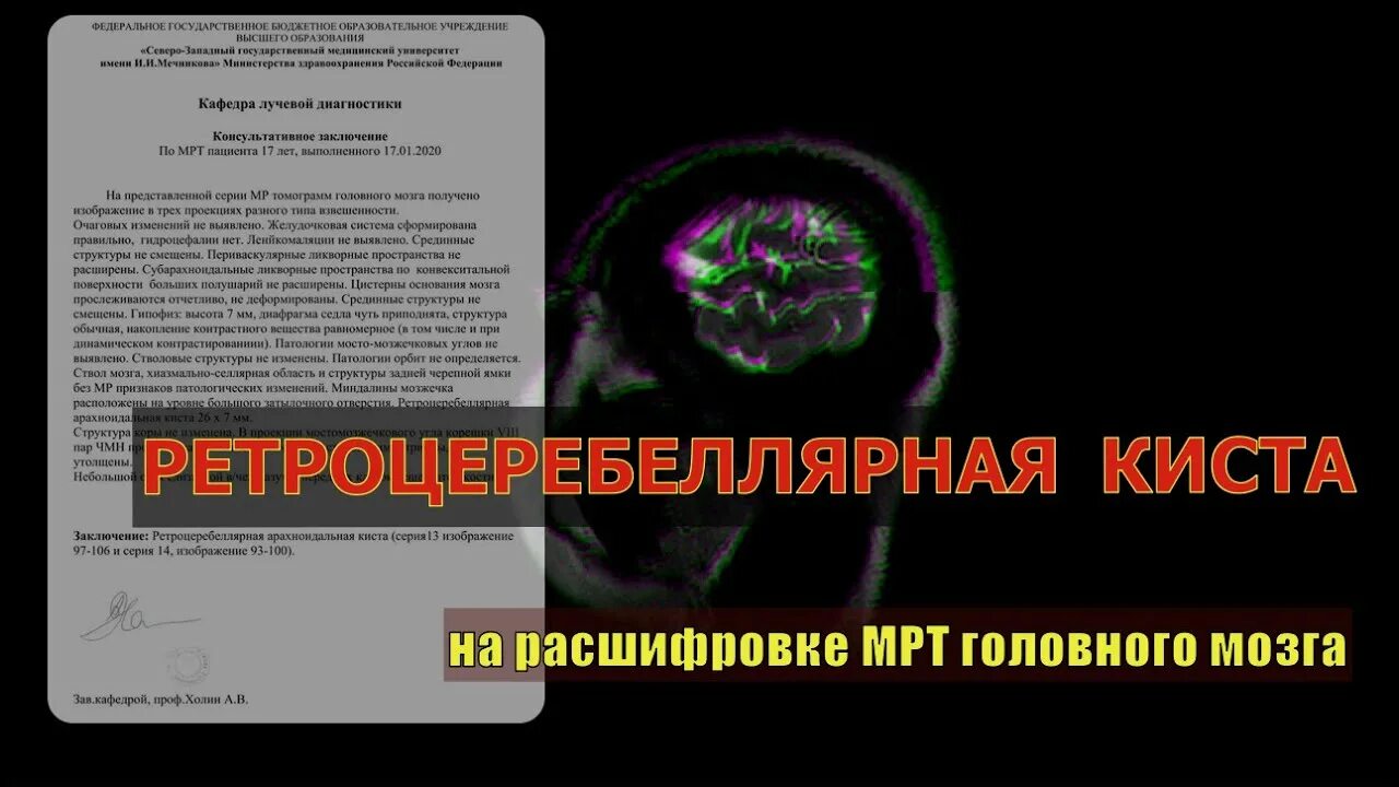Ретроцеребеллярная арахноидальная киста в головном мозге на мрт. Арахноидальная ликворная киста мрт. Ретроцеребеллярная киста головного мозга опасна. Заключение кт ретроцеребеллярная киста головного мозга. Ретроцеребеллярная киста головного мозга опасна.