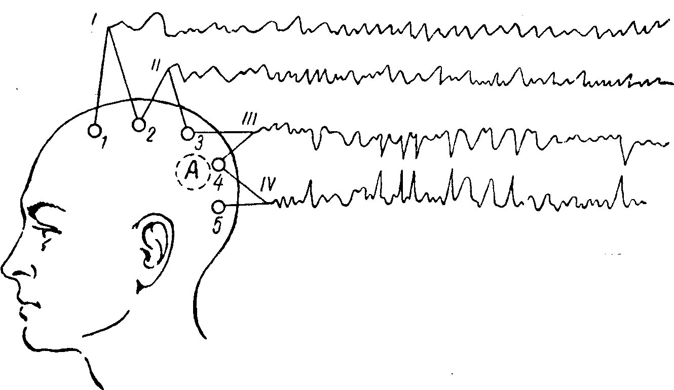 Система ээг. ЭЭГ головного мозга наложение электродов. Электроды при ЭЭГ. Схема наложения датчиков ЭЭГ. Электроэнцефалография головного мозга (ЭЭГ).