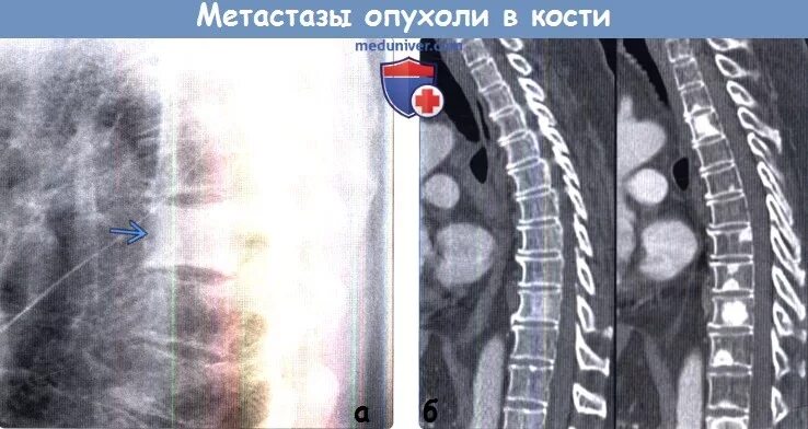 Anterior aspect of the sternum. Arrows indicate location of lytic lesions. Downl