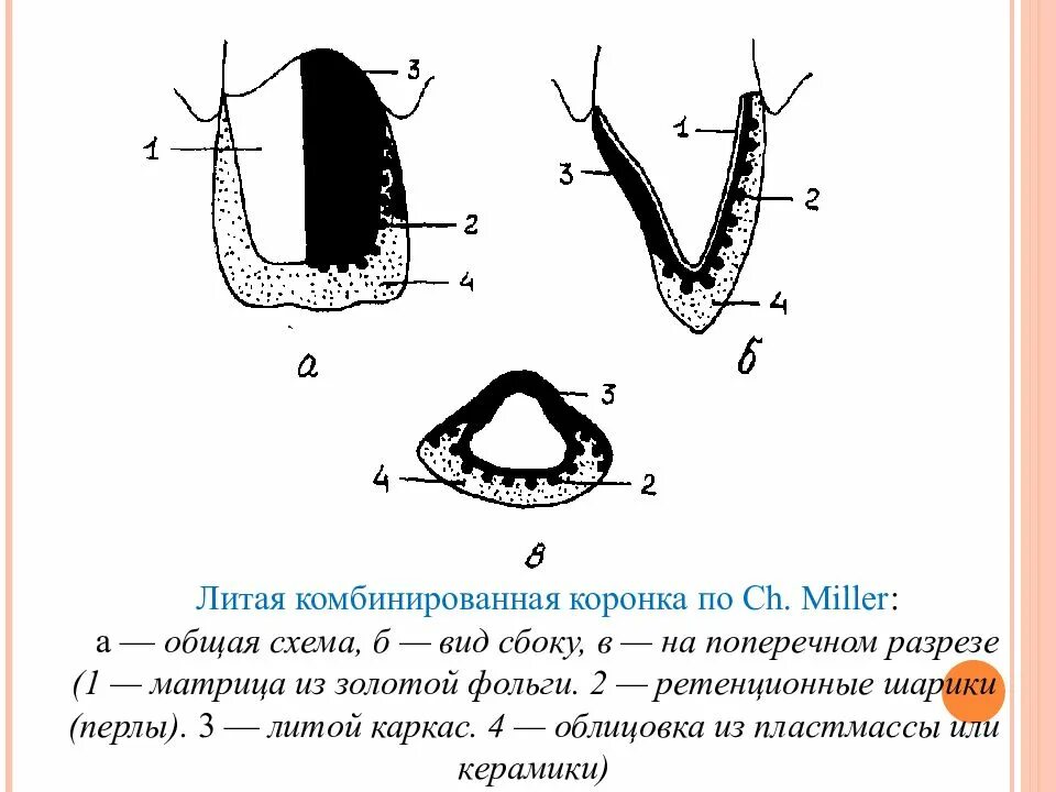 Литая металлопластмассовая коронка схема. Комбинированная коронка по Белкину схема. Литая комбинированная коронка. Комбинированная коронка схематично. Какую функцию выполняет коронка зуба