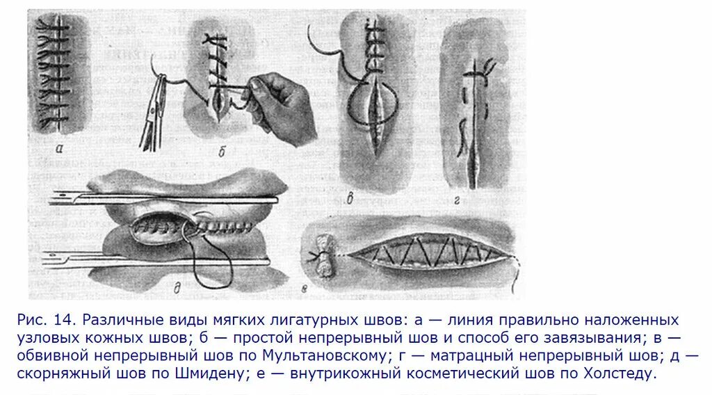 Техника наложения хирургических швов. Зашивание РАН хирургия. Техника наложения швов в хирургии. Шов зашивание операция. Узловатый шов хирургия.