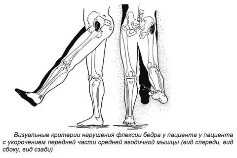 Боль в средней ягодичной