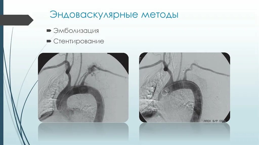 Эмболизация. Эндоваскулярные операции эмболизация. эндоваскулярная эмболизация гастродуоденальной артерии. эмболизация кровоточащего сосуда. эндоваскулярная эмболизация артерий желудка.
