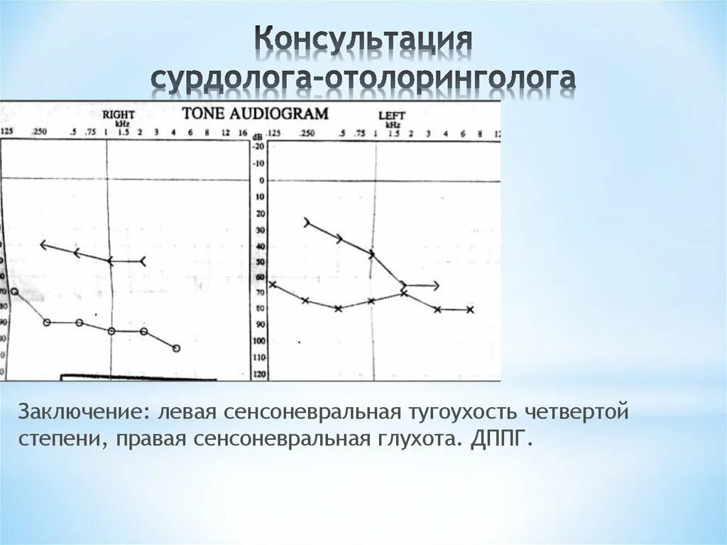 Заключение сурдолога. Справка от сурдолога. Справка о нервном срыве. Заключение сурдолога. Как выглядит заключение сурдолога.