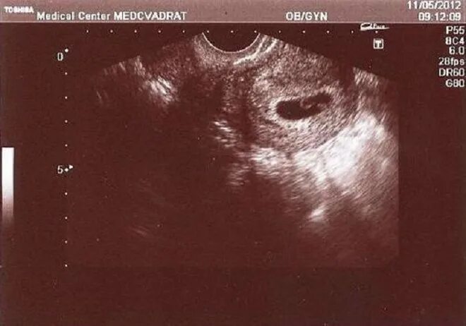 Узи эмбриона 7 недель. Плод на 7 неделе беременности УЗИ. УЗИ ребенка на 7 неделе беременности. УЗИ 6-7 недель беременности фото.