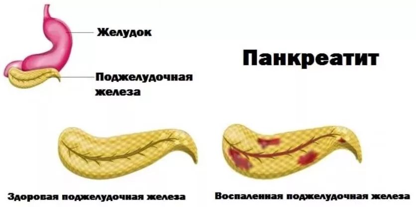 Панкреатит навсегда. Здоровая поджелудочная железа. панкреатит желудочной железы. воспаление поджелудочной железы у ребенка.