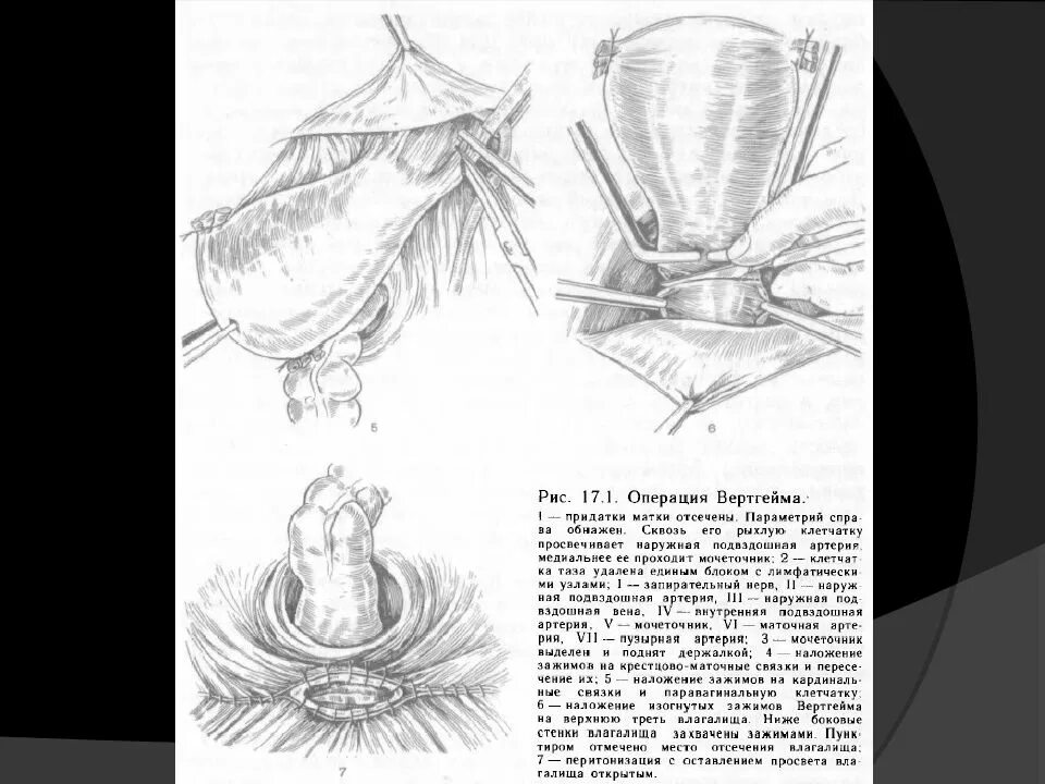 Сечение матки операция. Маточный манипулятор для гистерэктомии. Протокол операции влагалищной экстирпации матки. Параметрий и периметрий матки. Малоинвазивная операция на матке.