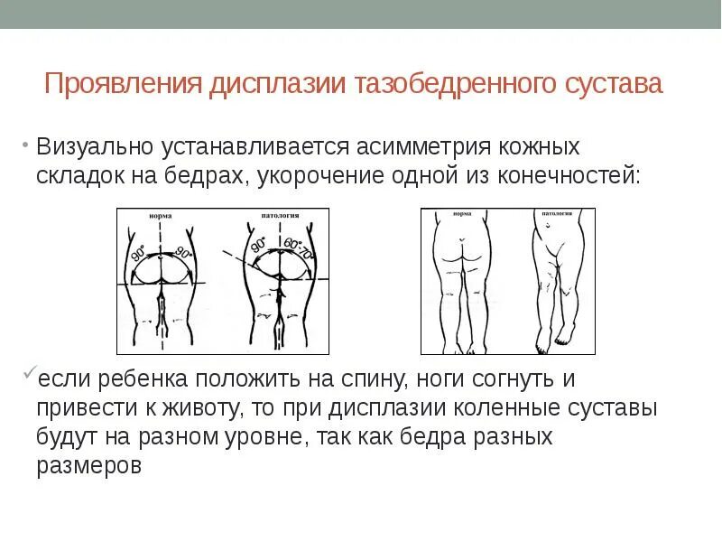 Дисплазия сустава у новорожденного лечение