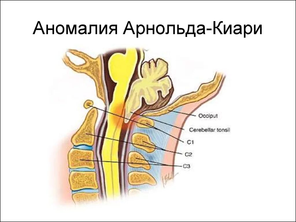 Аномалия арнольда киари что это простыми. Аномалия Киари сирингомиелия. Арнольда Киари аномалия снимки. Аномалия Киари 1 операция.