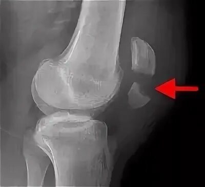 Трещина в коленной. Перелом надколенника рентген. Перелом коленной чашечки рентген. Смещение коленной чашечки рентген. Вывих надколенника рентген.