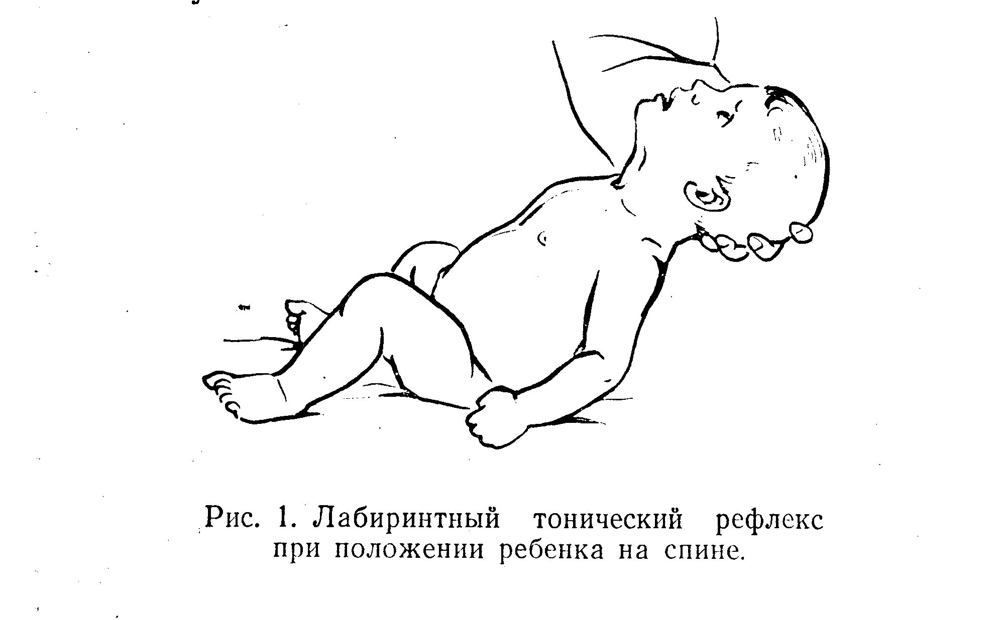 Лабиринтный тонический рефлекс у новорожденных. Лабиринтный тонический рефлекс при ДЦП. Тонические рефлексы при ДЦП. Симметричный шейный тонический рефлекс при ДЦП.