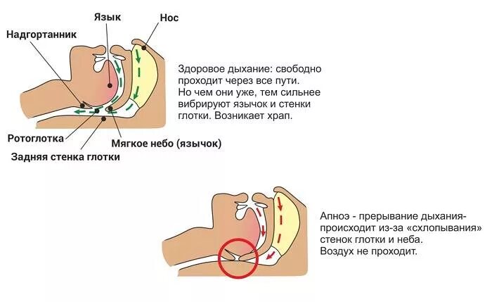 Почему появляется храп. Храп механизм возникновения. Влияет ли лишний вес на храп. Физиология храпа человека.