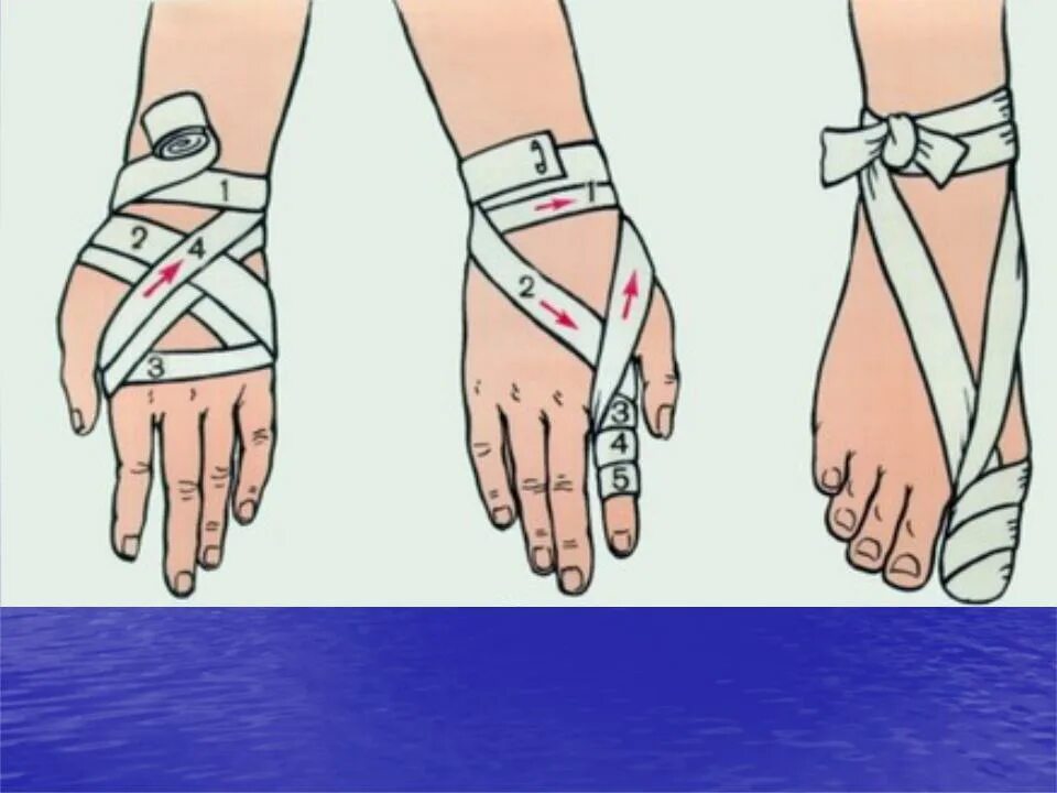 Техника наложения повязки на кисть. Восьмиобразная повязка на лучезапястный сустав. Крестообразная (восьмиобразная) повязка на кисть. Наложите бинтовую повязку на 1 палец кисти. Наложение повязки на палец.