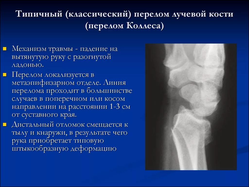 Мыщелковый перелом лучевой кости. Перелом лучевой кости рентген заключение. Перелом лучевой кости рентген описание. Перелом метафиза лучевой кости.