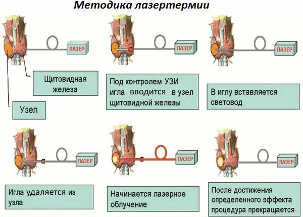 Почему образуются узлы. Как удаляют щитовидный узел. Как выглядят щитовидные узлы. Лазерная деструкция щитовидной железы. Операция узел щитовидной железы.