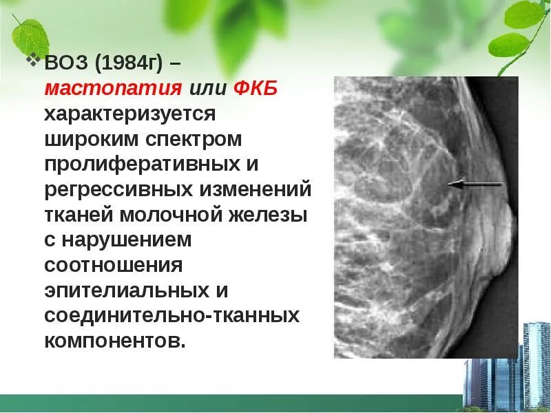 Диагноз ФКБ молочных желез что это. Диффузная кистозная мастопатия. Мастопатия презентация. Признаки фиброзных изменений молочных желез