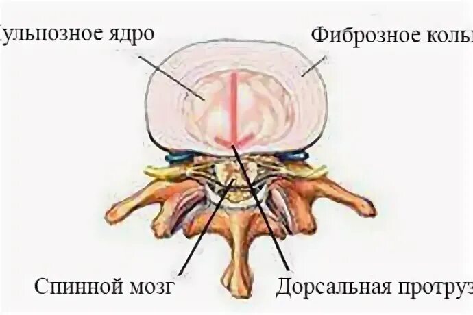 Дорсальная протрузия