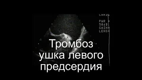 Тромб ушка левого предсердия