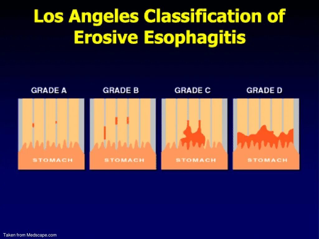 Эрозивный эзофагит классификация. Классификация Лос Анджелес эзофагит. Классификация Лос Анджелес. Лос Анджелесская классификация эзофагитов. Лос-Анджелесская классификация рефлюкс-эзофагита.