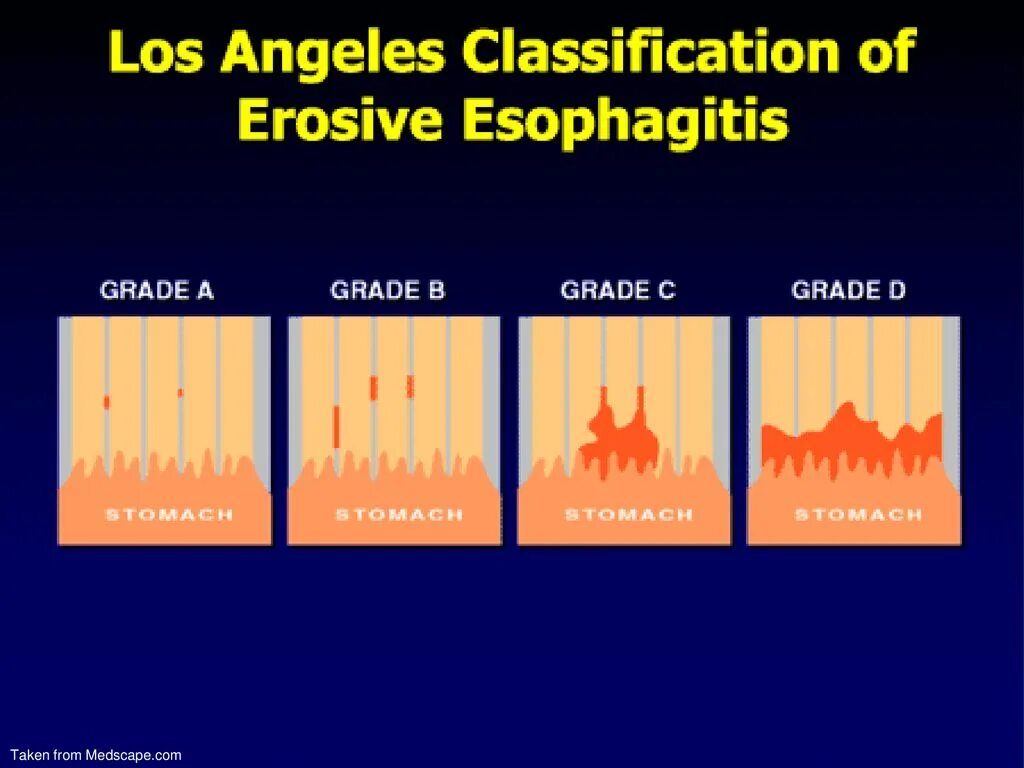 Рефлюкс эзофагит классификация. Классификация Лос Анджелес эзофагит. Классификация Лос Анджелес. Лос Анджелесская классификация эзофагитов. Лос-Анджелесская классификация рефлюкс-эзофагита.