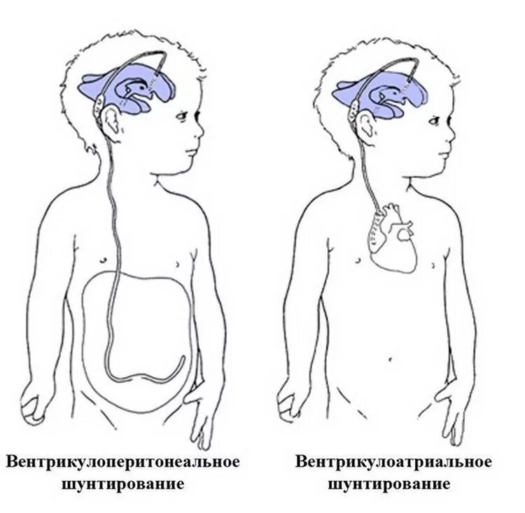 Головные шунты. Шунтирующие операции при гидроцефалии. Шунт в голове при гидроцефалии. Шунтирование мозга гидроцефалия головного мозга у ребенка. Вентрикулоперитонеальный шунт схема.