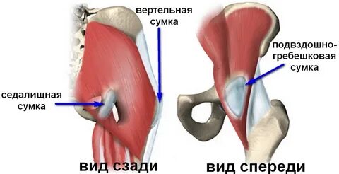 Тендинит средней ягодичной
