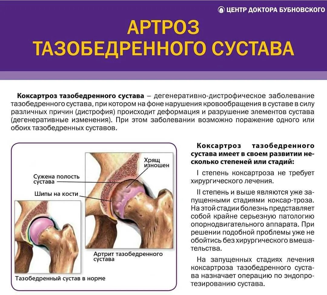 Тазобедренный артрит симптомы. Деформирующий остеоартроз тазобедренного сустава ii степени. заболевание артроз тазобедренного сустава. артрит артроз тазобедренного сустава.